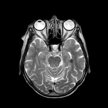 Une malade atteinte d'Alzheimer sort sans surveillance de l'hôpital Une malade atteinte d'Alzheimer sort sans surveillance de l'hôpital